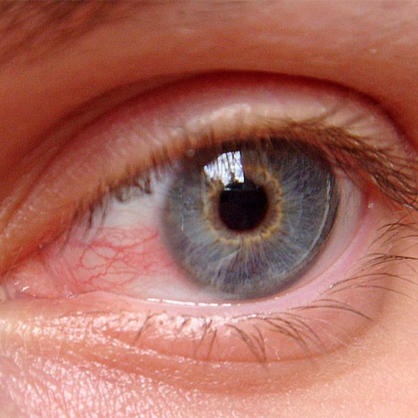 ¿Qué es el Glaucoma?